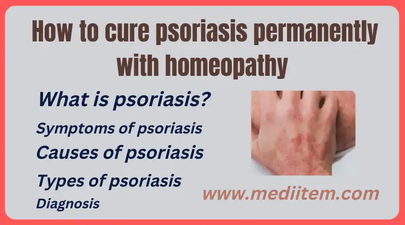 How to cure psoriasis permanently with homeopathy