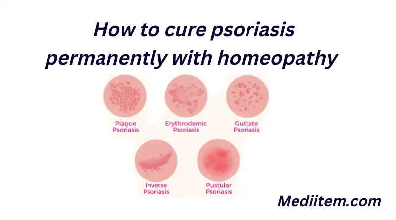 Types of psoriasis and How to cure psoriasis permanently with homeopathy