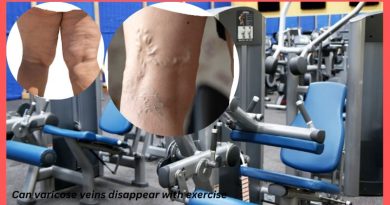 Can varicose veins disappear with exercise