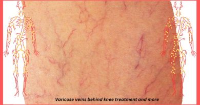 Varicose veins behind knee treatment and more