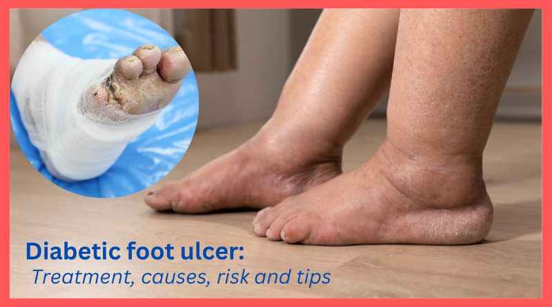 Diabetic foot ulcer treatment, causes, risk and tips