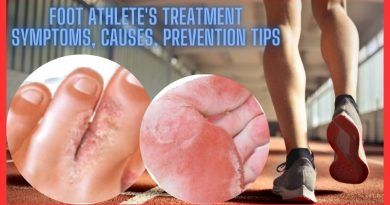 Foot athlete's treatment, symptoms, causes, prevention tips