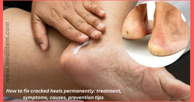How to fix cracked heels permanently treatment, symptoms, causes, prevention tips