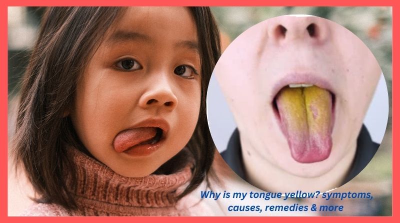 Why is my tongue yellow symptoms, causes, remedies & more
