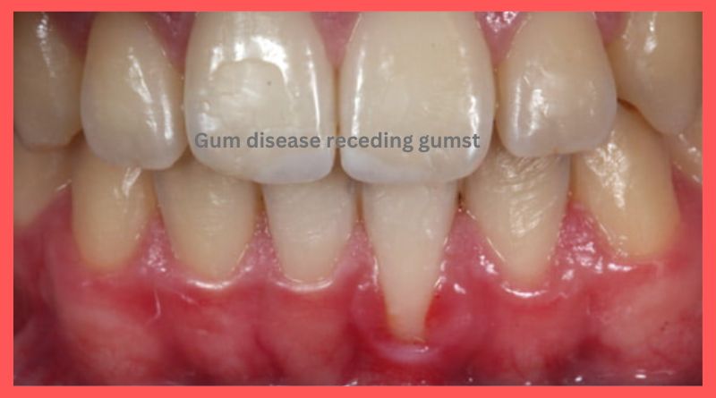 Gum disease receding gums treatment