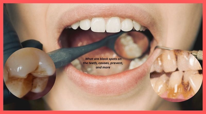 What are black spots on the teeth, causes, prevent, and more