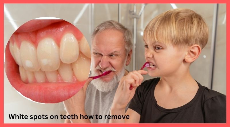 White spots on teeth how to remove