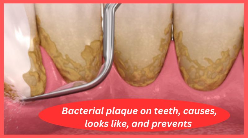 Bacterial plaque on teeth, causes, looks like, and prevents