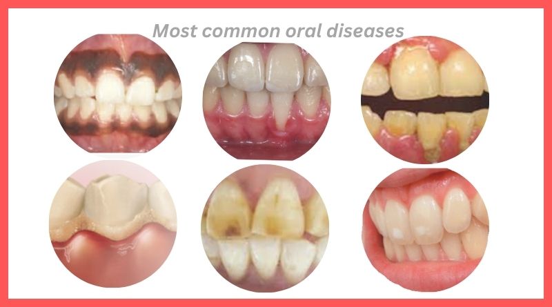 Most common oral diseases