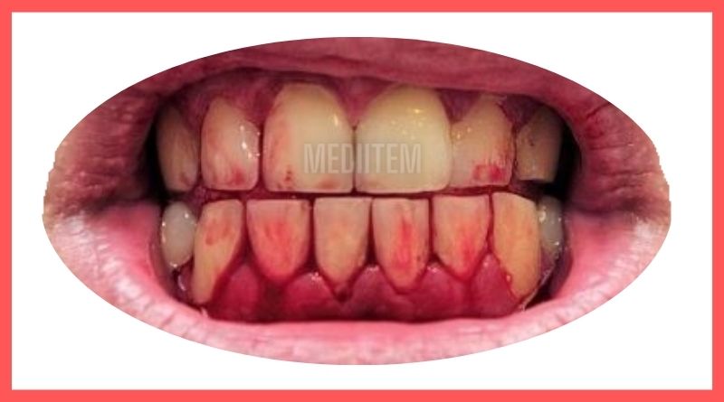 Why do my gums bleed when i brush my teeth