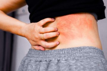 এলার্জি চুলকানি রোগ